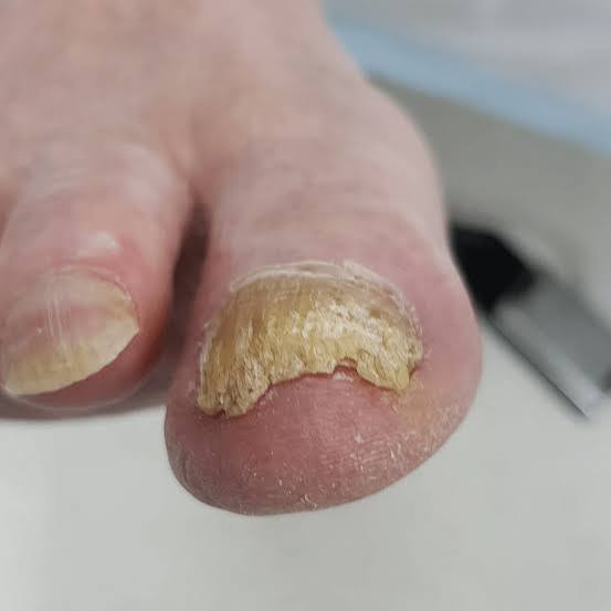Toenail Fungus Signs: What to Know