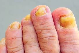 Toenail Fungus Signs: Common Questions Answered
