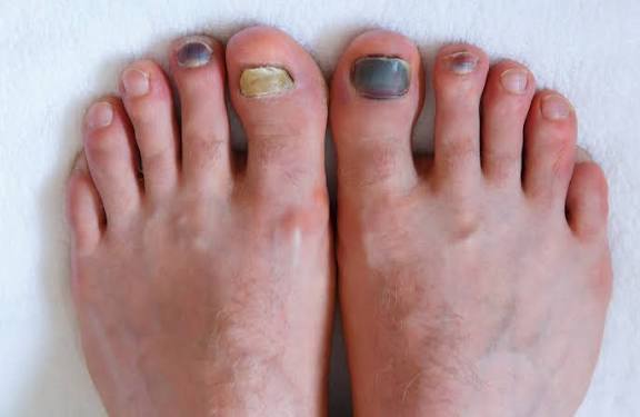 Toenail Fungus Signs: A Beginner's Guide