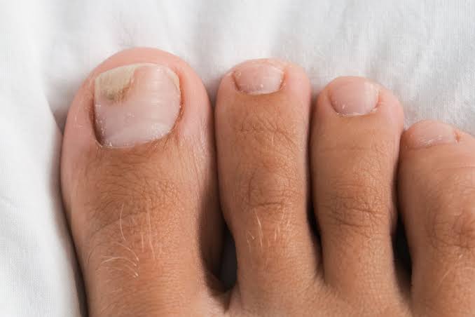 Toenail Fungus Signs: Safety Tips