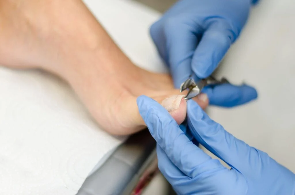 Toenail Fungus Signs: A Beginner's Guide