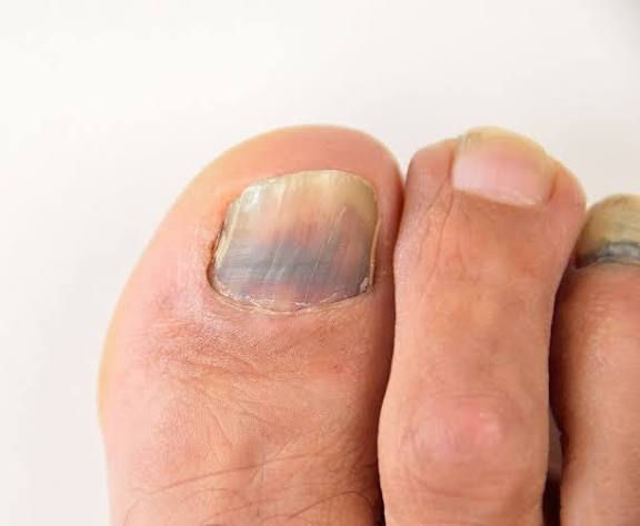 Toenail Fungus Signs: Signs and Causes