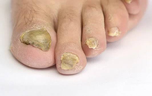 Toenail Fungus Signs: What to Know